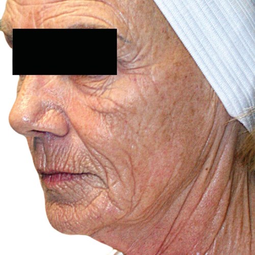 wrinkle reduction 2 before