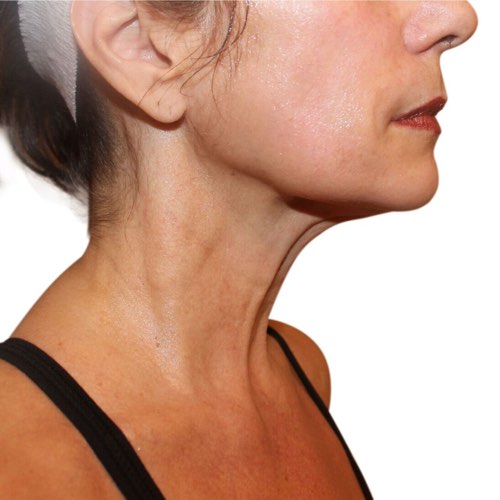 wrinkle reduction 3 after