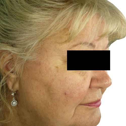 skin rejuvenation 1 after