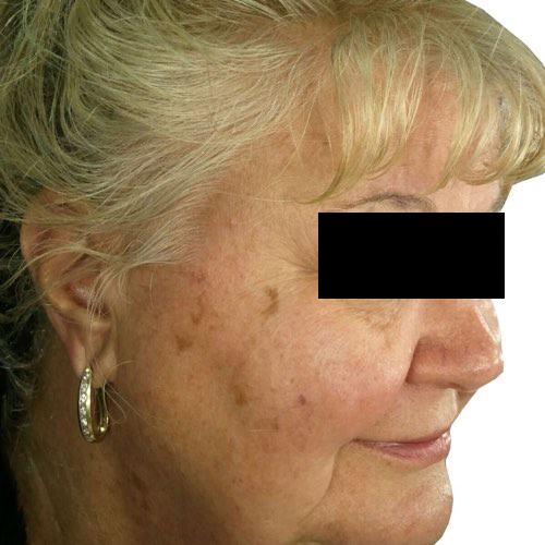skin rejuvenation 1 before