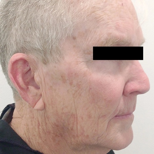 tribella en 3 before 2