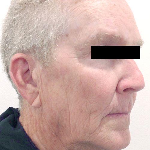 tribella en 3after 2