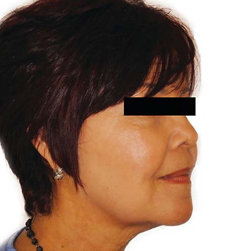 venus freeze plus 2 after