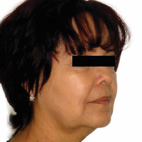 venus freeze plus 2 before