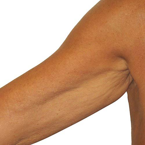 venus freeze plus 4 after