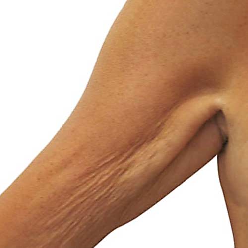 venus freeze plus 4 before