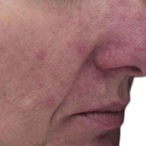 viva rosacea 2 after