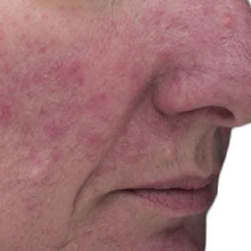 viva rosacea 2 before