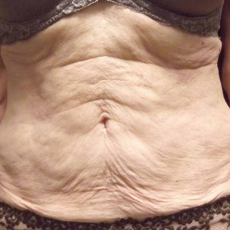 legacy loose skin before