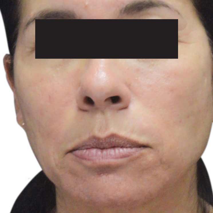 microneedling after1