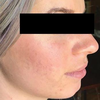 microneedling after2