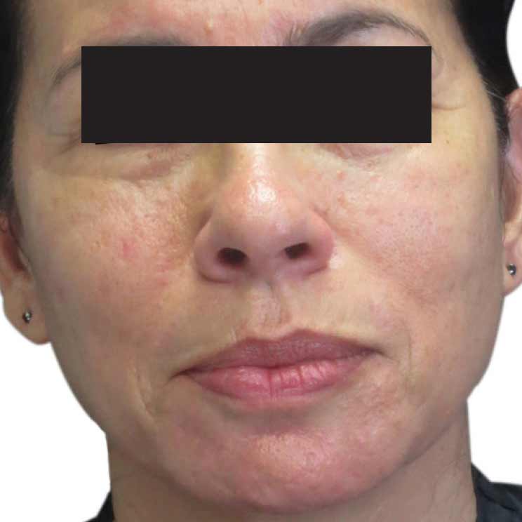 microneedling before1