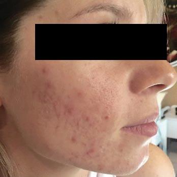 microneedling before2