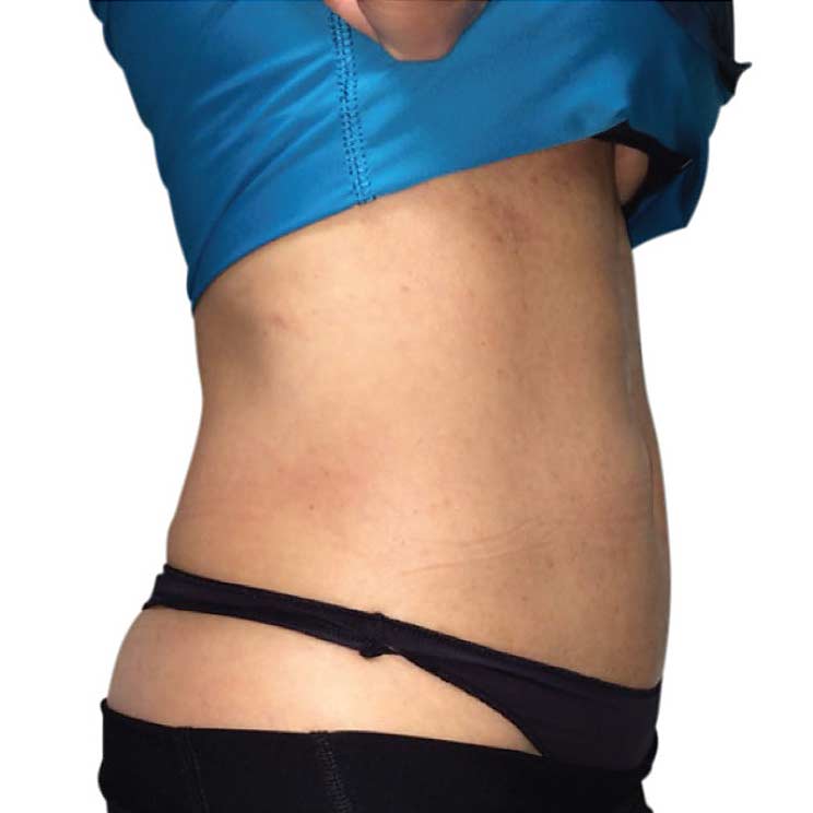 venus legacy postlipo after