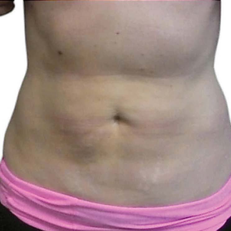 venus legacy postlipo after2