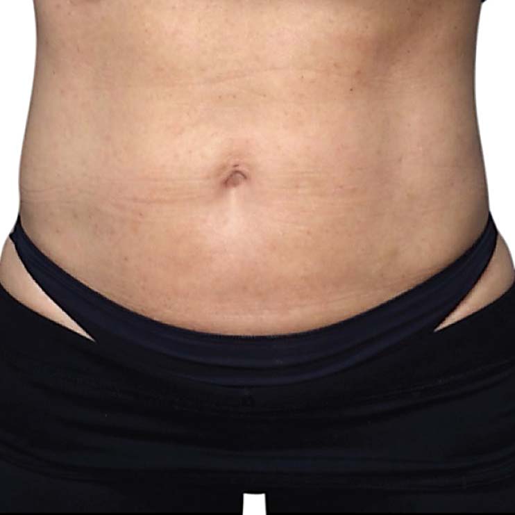 venus legacy postlipo after3