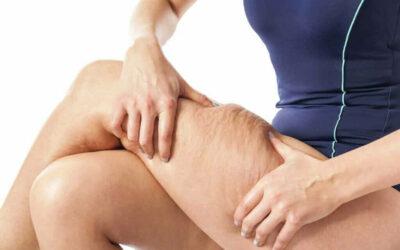 The Formation of Cellulite