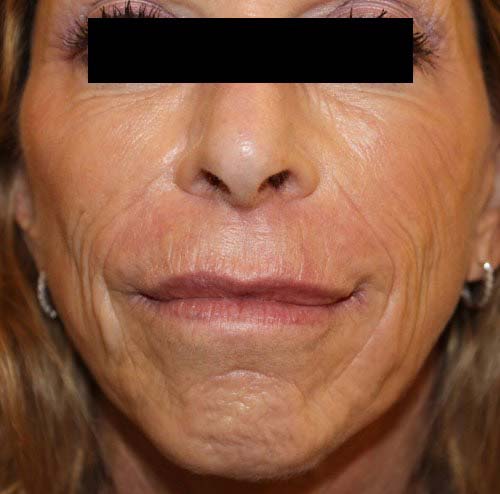wrinkle reduction 1 before