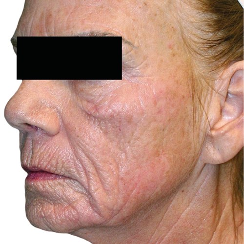wrinkle reduction 2 after