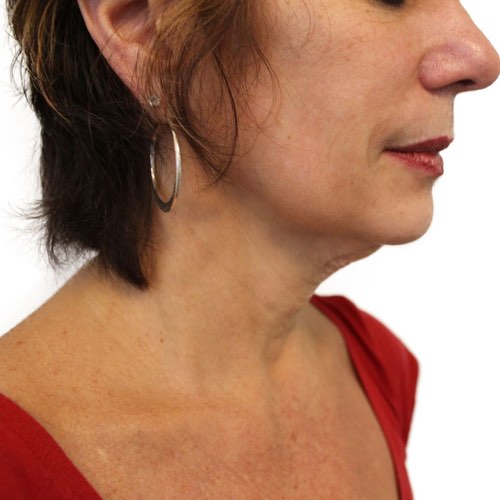 wrinkle reduction 3 before