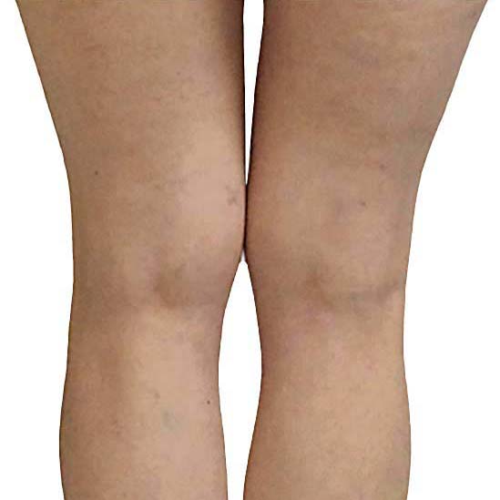 Edema Treatment 1 LegsBefore2