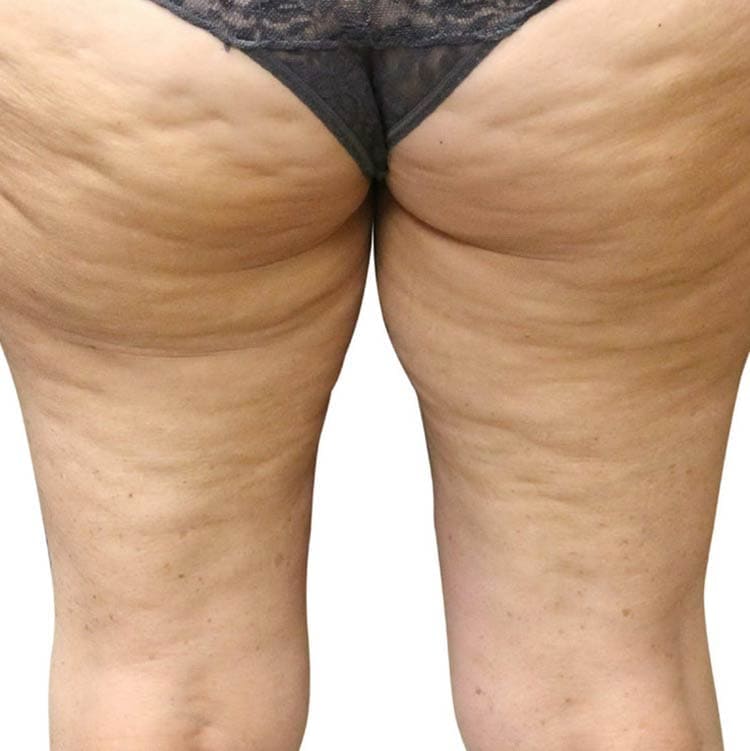 Cellulite Treatment 1 VenusLegacy cellulite before 2