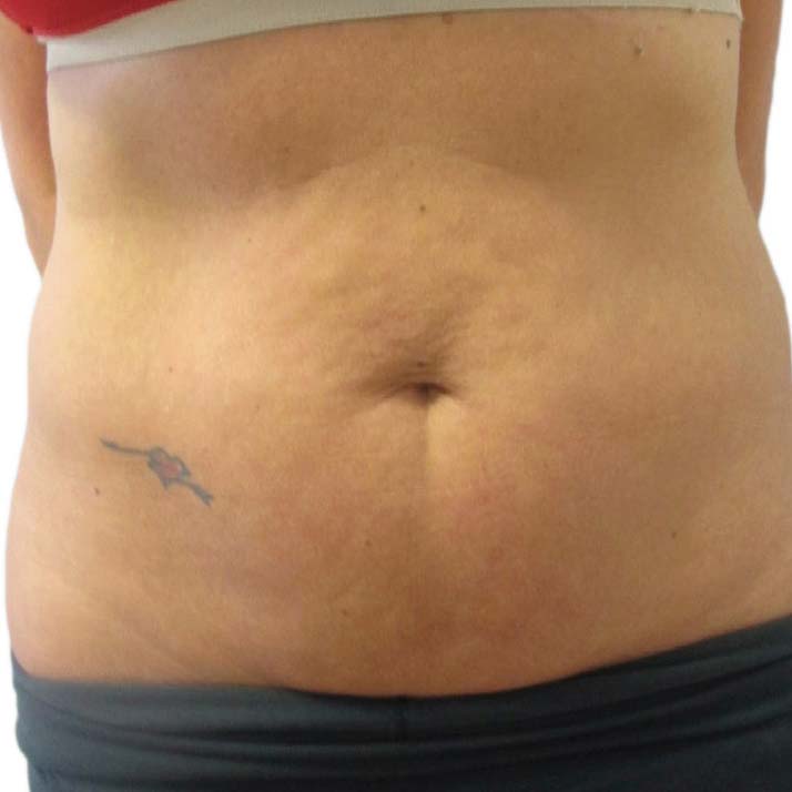 Cellulite Treatment 3 VenusLegacy cellulite before 3