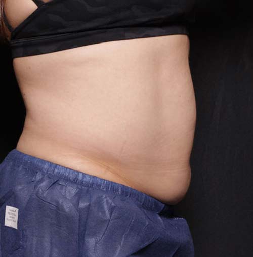 Belly Fat Reduction 1 bliss 1 before