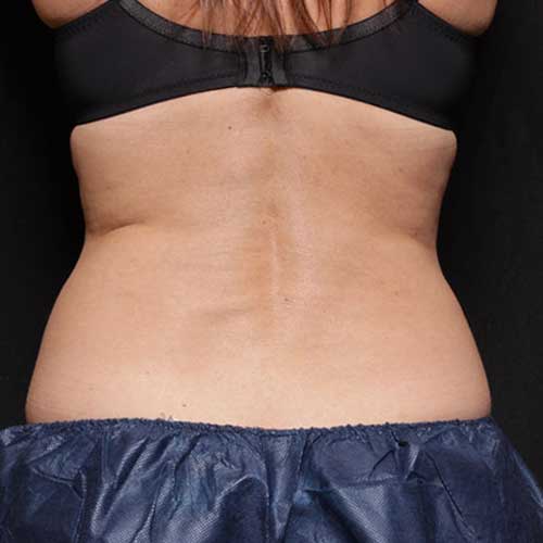 Belly Fat Reduction 5 bliss 2 before