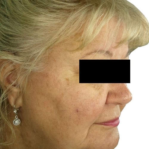 skin rejuvenation 1 after