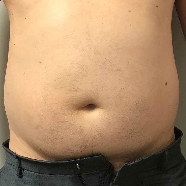 Belly Fat Reduction 3 venus bliss before picture