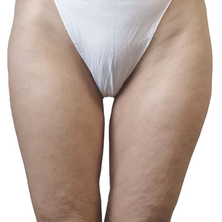 Cellulite Treatment 5 venus cellulite before 1