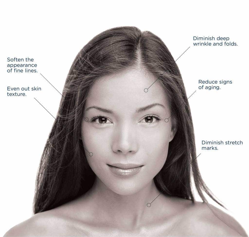 microneedling