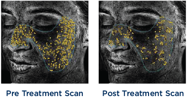 VISIA Scan2