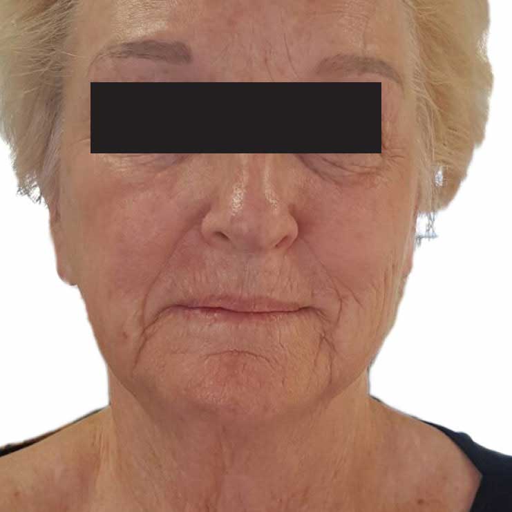 IPL after treatment