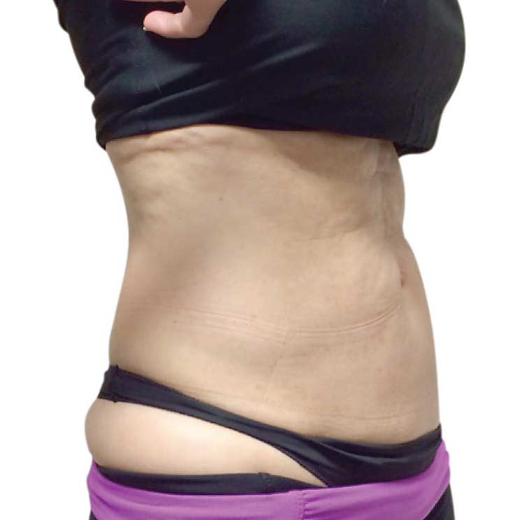 Post-Liposuction Fibrosis Treatment 3 venus legacy postlipo before