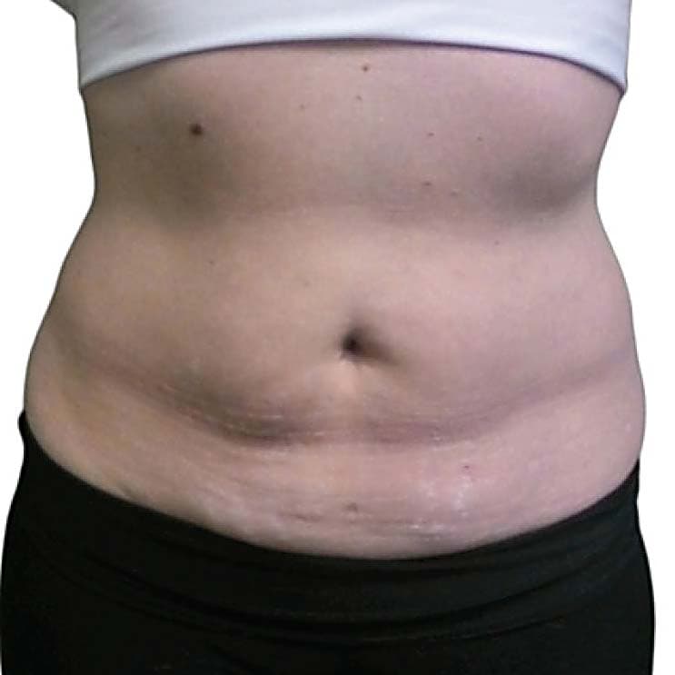 Post-Liposuction Fibrosis Treatment 5 venus legacy postlipo before2
