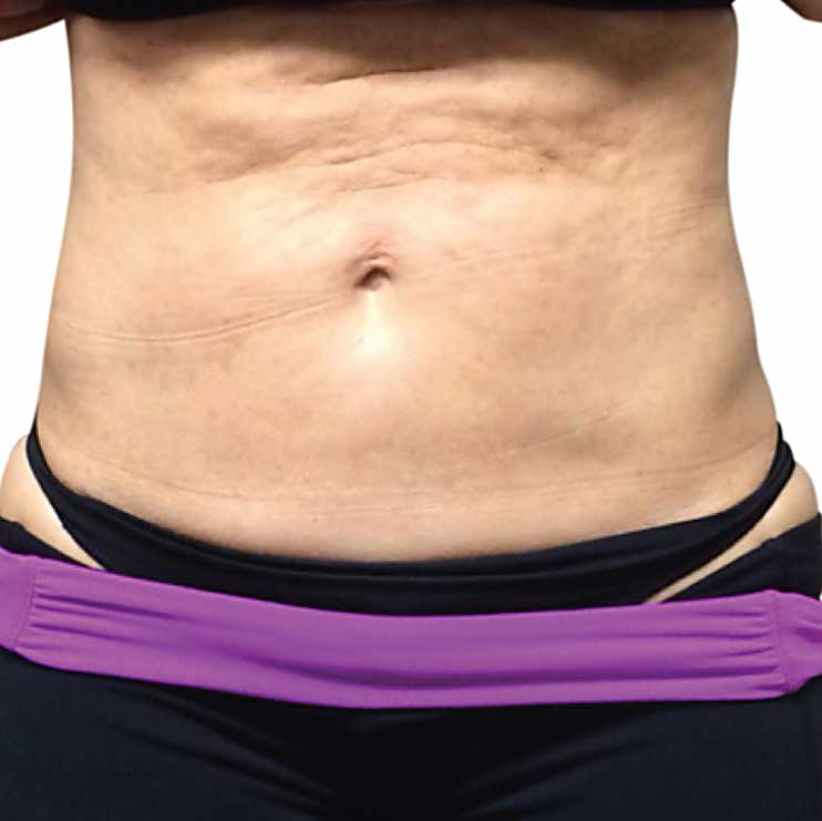 Post-Liposuction Fibrosis Treatment 1 venus legacy postlipo before3
