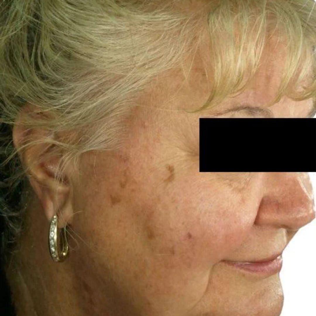 before treatment