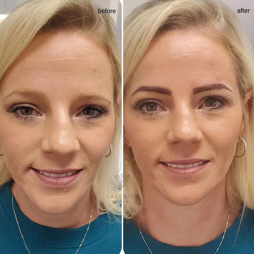 Brow microblading